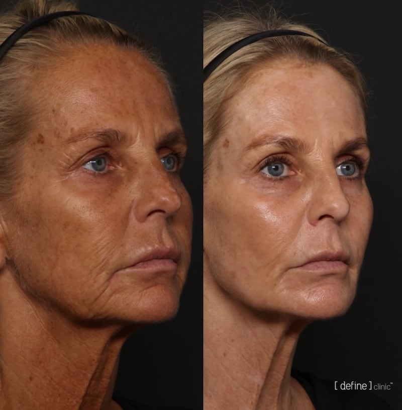 Ulrika Jonsson underwent six months of injection, laser, and ultrasound treatments to achieve her incredible results.