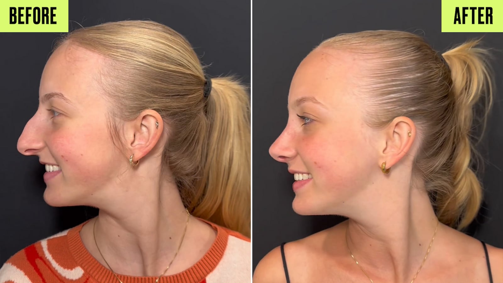 Before and After: Side View