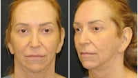 This Woman Underwent Surgery to Fix Common GLP-1 Side Effects - The Looker