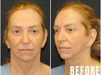 This Woman Underwent Surgery to Fix Common GLP-1 Side Effects - The Looker