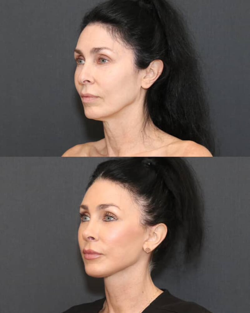 Side profile transformation of Dr. L. Mike Nayak’s patient, Kelly Morgan — before and after.