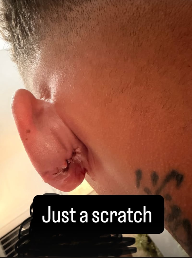 Kane Brown shares an up-close picture on his Instagram story of his ear with stitches after being struck by a golf ball.