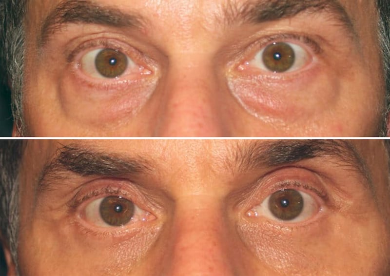 Lower blepharoplasty eyelid surgeries before and after.