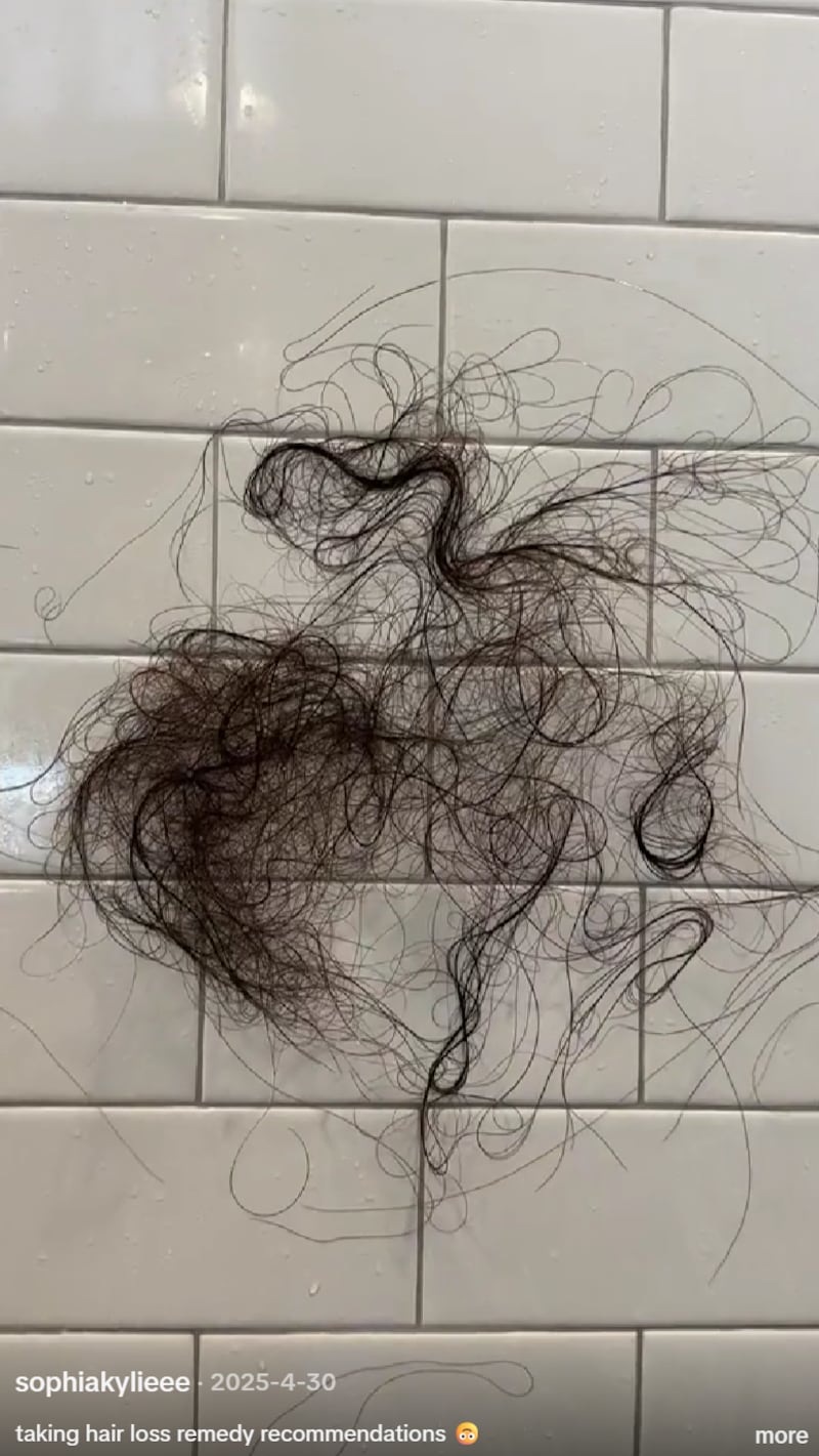 Umansky showed her followers the rapid hair shedding she experienced after taking GLP-1 medication.
