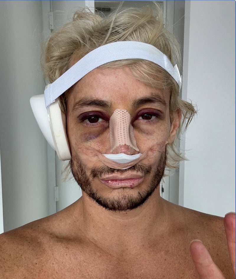 Frankie Grande shares a photo on his Instagram after his Rhinoplasty in 2024, with the caption “New nose who dis?”
