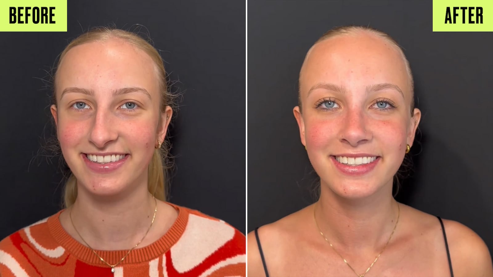 Before and After: Front View