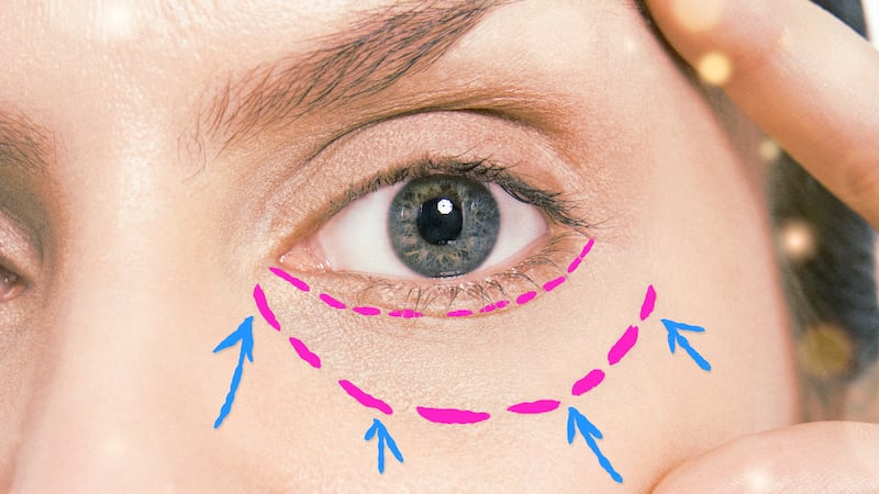A photo illustration of lower blepharoplasty eyelid surgery markings.
