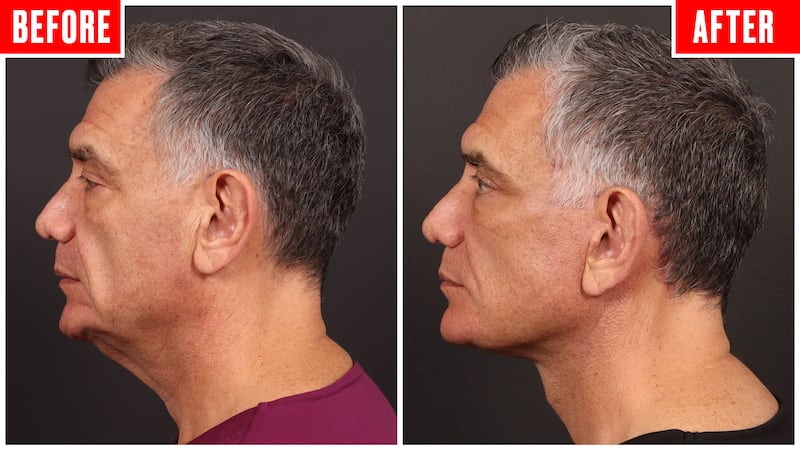 Before and after photos showing a couple who got face lifts