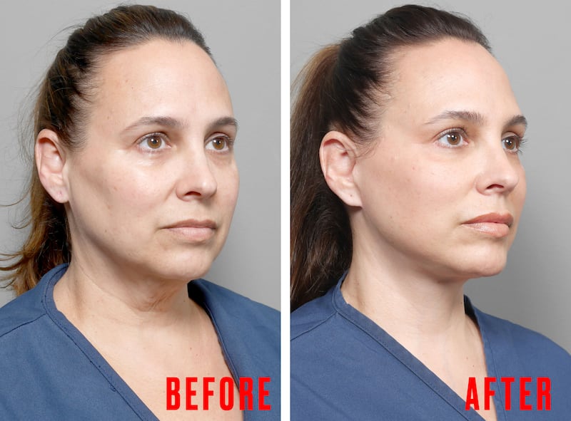 Woman Gets a Facelift After Losing 80 Pounds on GLP-1s for the Looker.