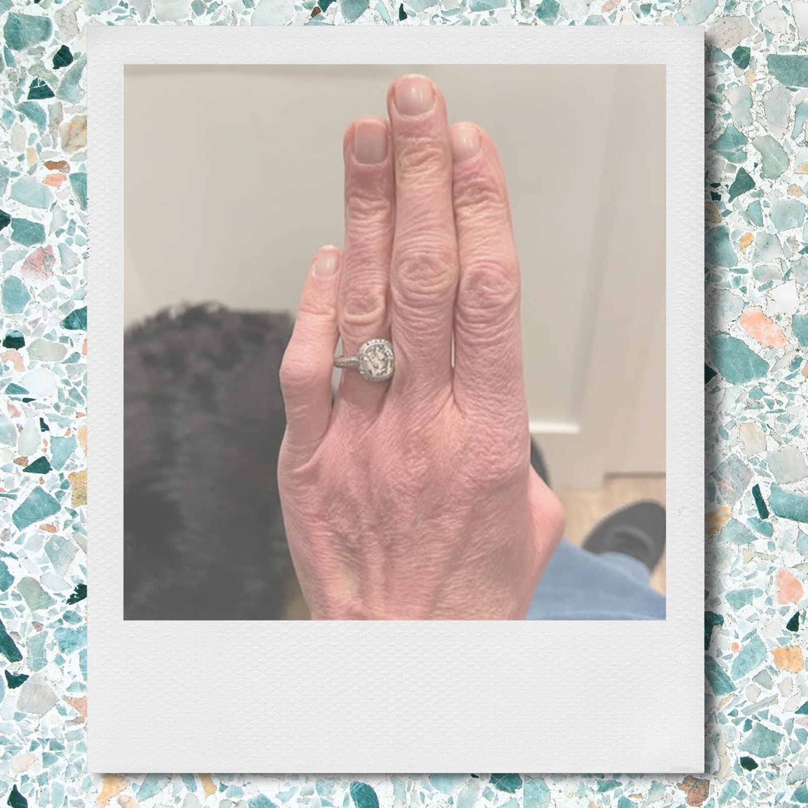 Before and after of filler use in the hand.