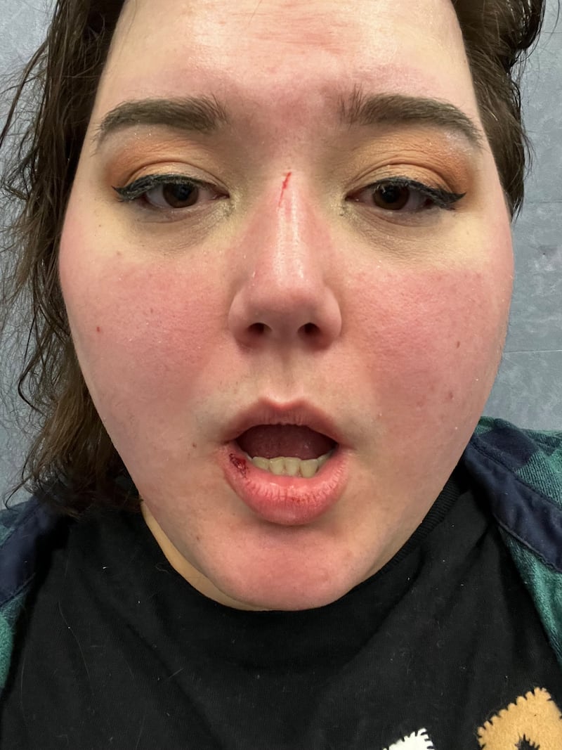 Blake sustained bruising and a busted lip.