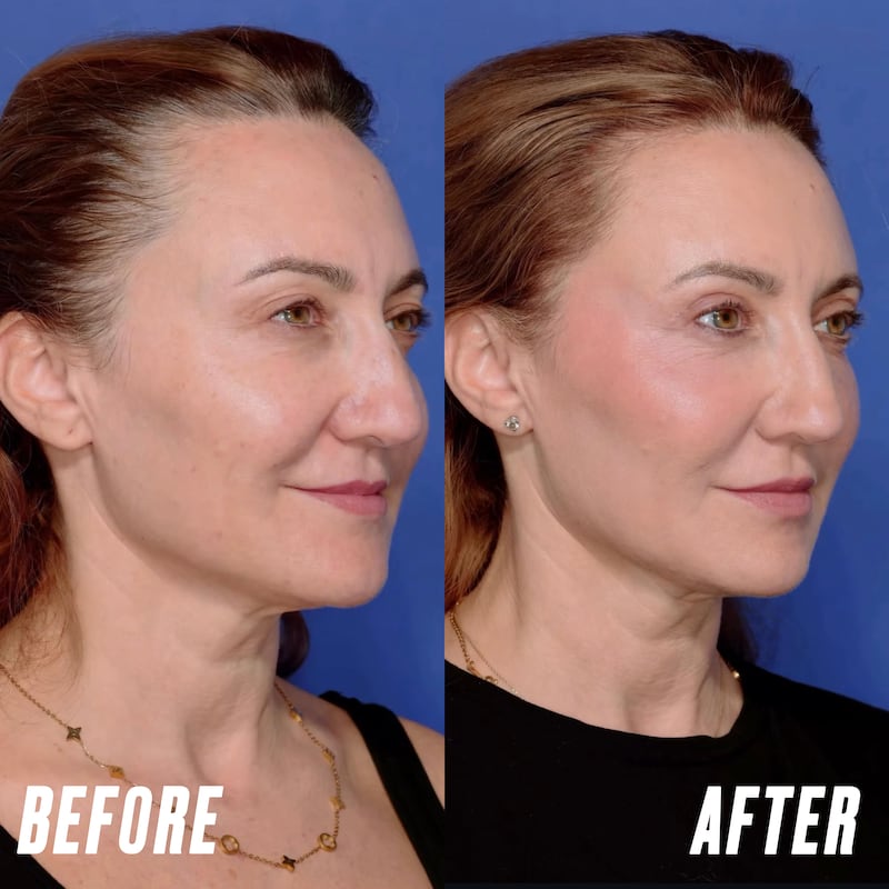 Looker - Her Upper Eyelid Surgery Took Just Two Hours But Took Years Off Her Face