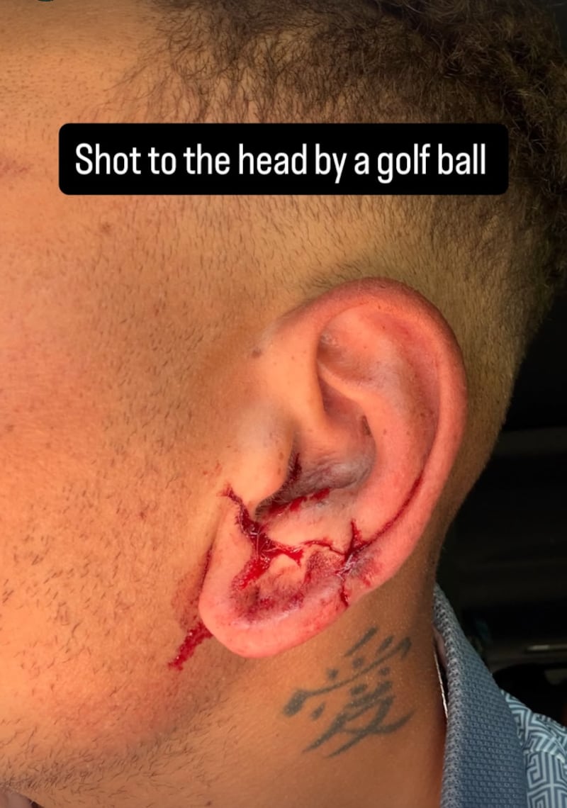 Kane Brown shares a photograph of his ear on his Instagram story after being struck by a golf ball.