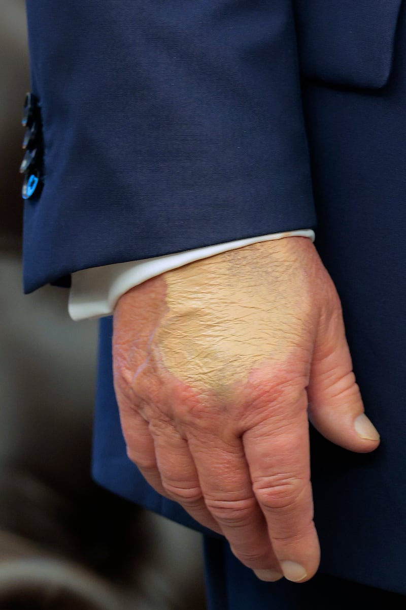 A patch of discolored skin is visible on the back of U.S. President Donald Trump's hand as he talks about the FIFA World Cup in the Oval Office at the White House on August 22, 2025 in Washington, DC.