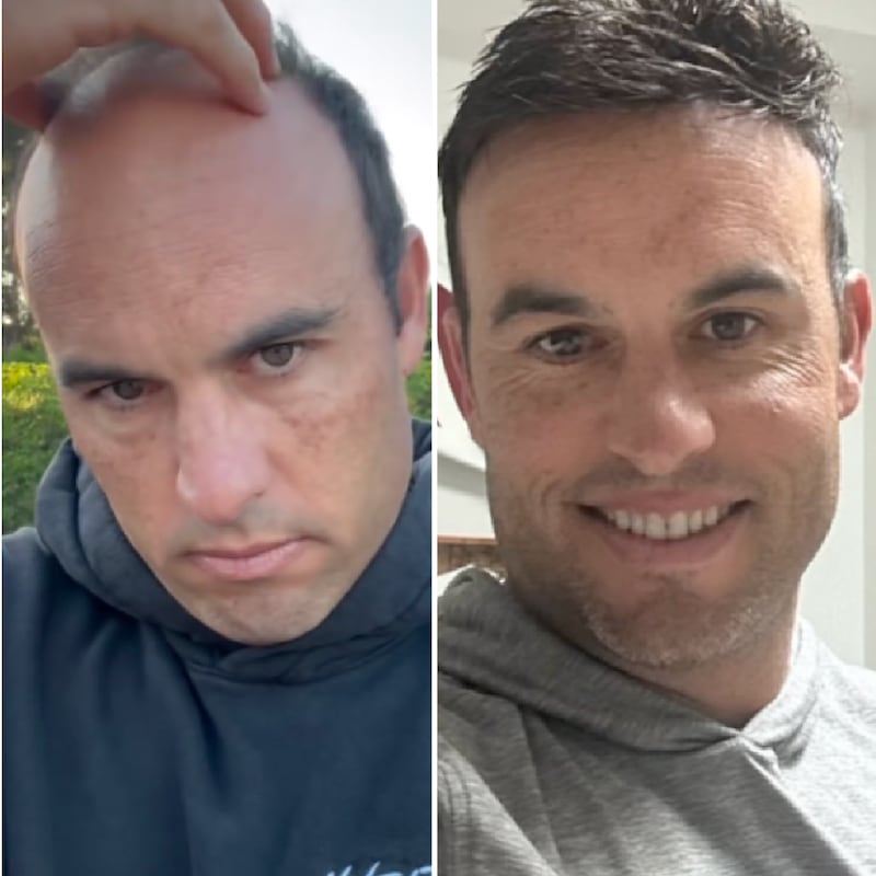 Landon Donovan before and after his hairpiece installation