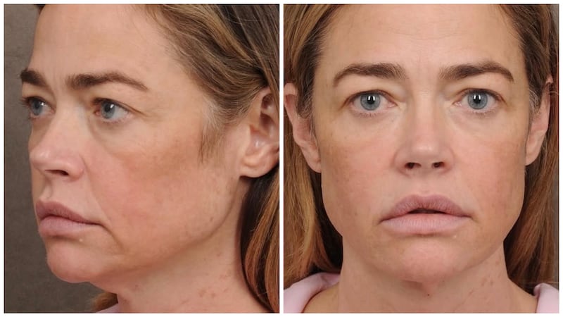 Denise Richards's face from two angles, prior to her face and neck lifts with Dr. Talei.