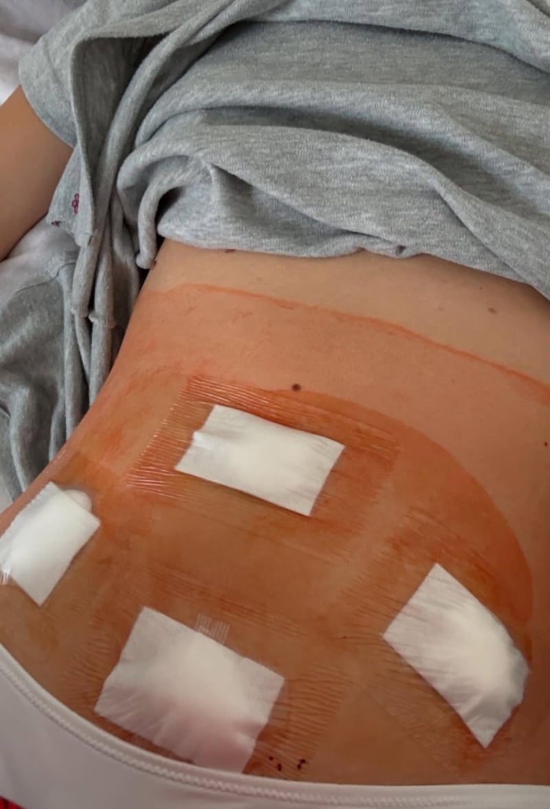 Barbara Palvin shares a picture of her lower abdomen after undergoing surgery to target her endometriosis.