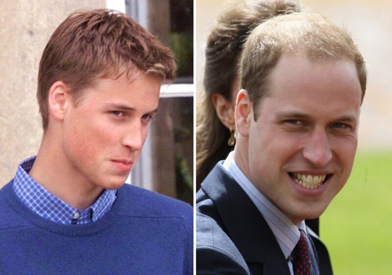 galleries/2011/04/25/bald-royals/bald-royals---prince-william_lnqjsf