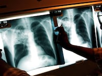 articles/2014/04/16/following-tuberculosis-from-death-sentence-to-cure/140515-Goetz-tb-death-sentence-tease_l7aseg