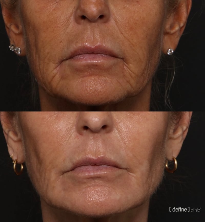 Six months into the treatments, the lines around Ulrika Jonsson's mouth were visibly diminished.