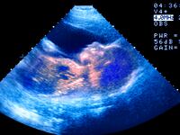ivf