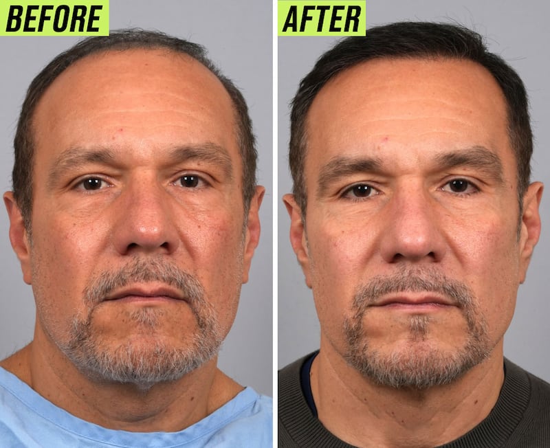 Male hair transformation before and after