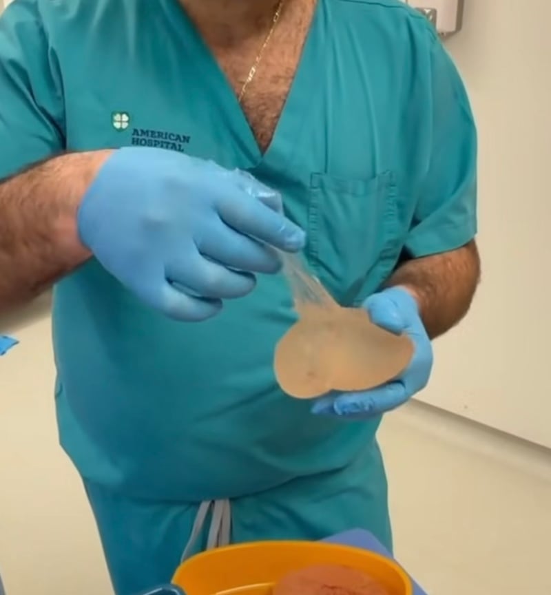 After the surgery, Dr. Samaha held Kattan's breast implant and showed how bad the rupture was.