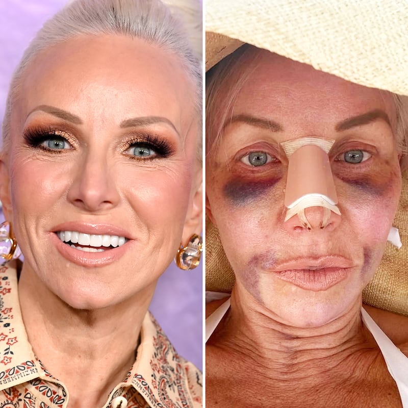 The Real Housewives of New Jersey star Margaret Josephs, 58, shared graphic pictures of her latest rhinoplasty, a fat transfer, and stem cell therapy.
