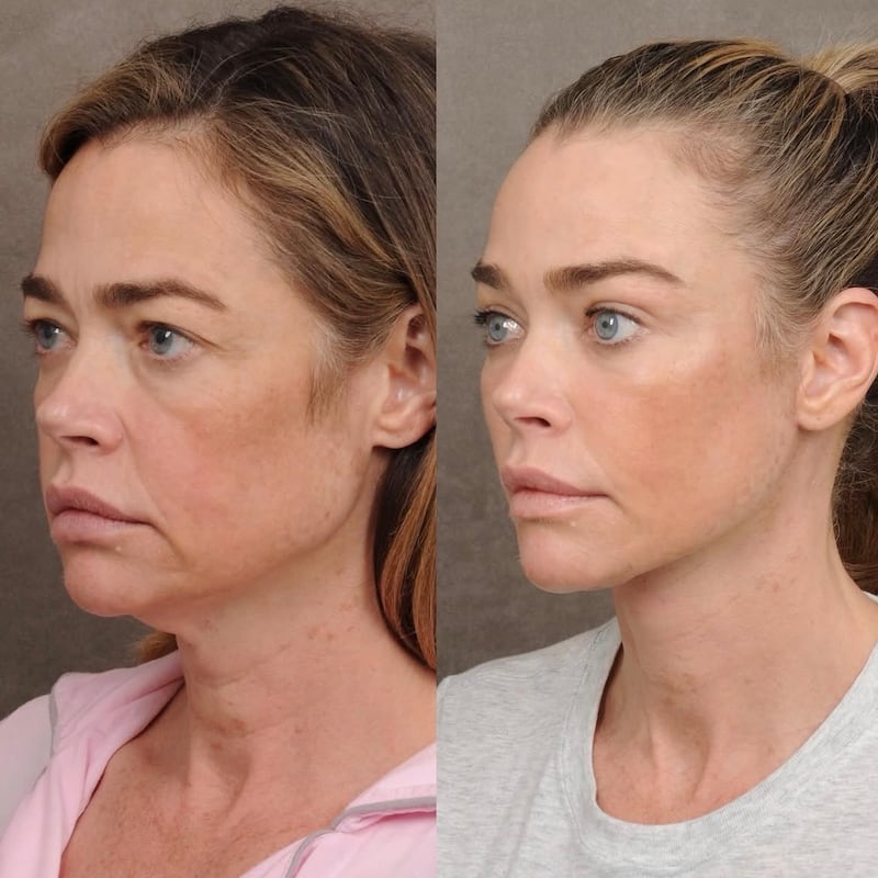 Denise Richards facelift