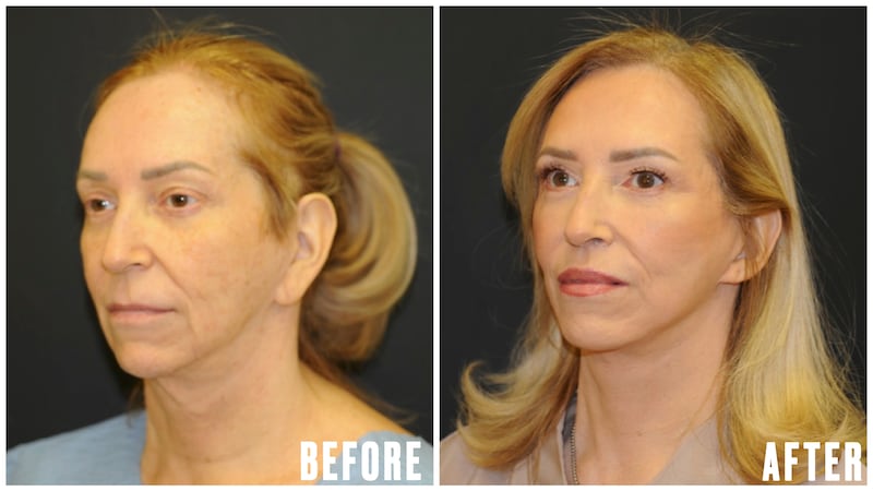 This Woman Underwent Surgery to Fix Common GLP-1 Side Effects - The Looker