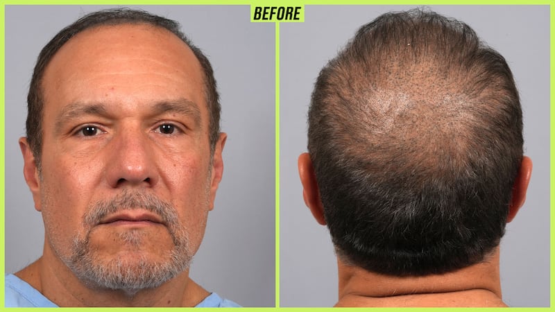 Male hair transformation before and after