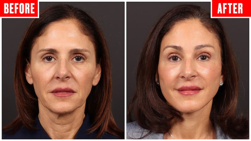 Before and after photos showing a couple who got face lifts