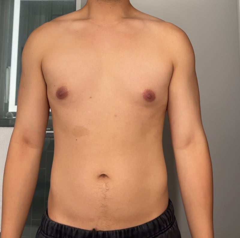Jon Michael's gynecomastia before.