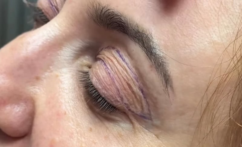 The client's upper eyelids prior to surgery. Dr. Olga Bachilo