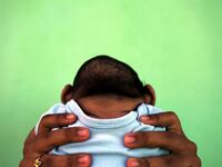 articles/2016/02/16/doctor-zika-virus-likely-causing-brain-damage-worse-than-what-you-re-told/160215-haglage-microcephaly-tease_l7bwox