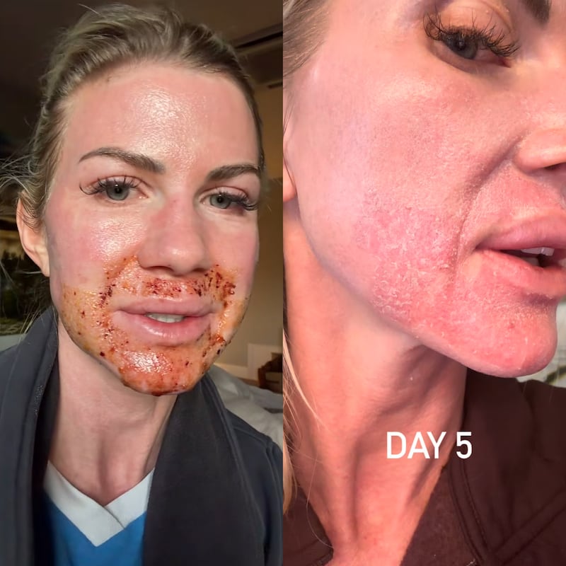 Raphaela Cohee's children were scared of her appearance after her first CO2 laser appointment. Five days later, her skin began to peel.