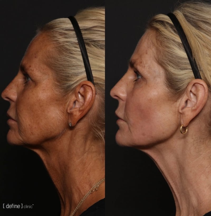 Ulrika Jonsson's skin was visibly more radiant following the knife-free transformation.