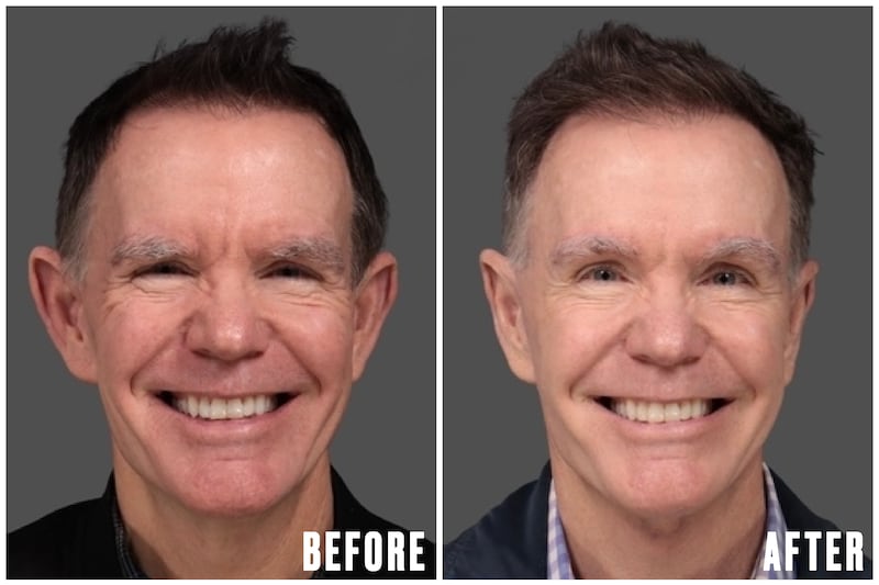 Before and After - The Looker - Man Undergoes Facelift After Noticing His Reflection Looked 'Angry'