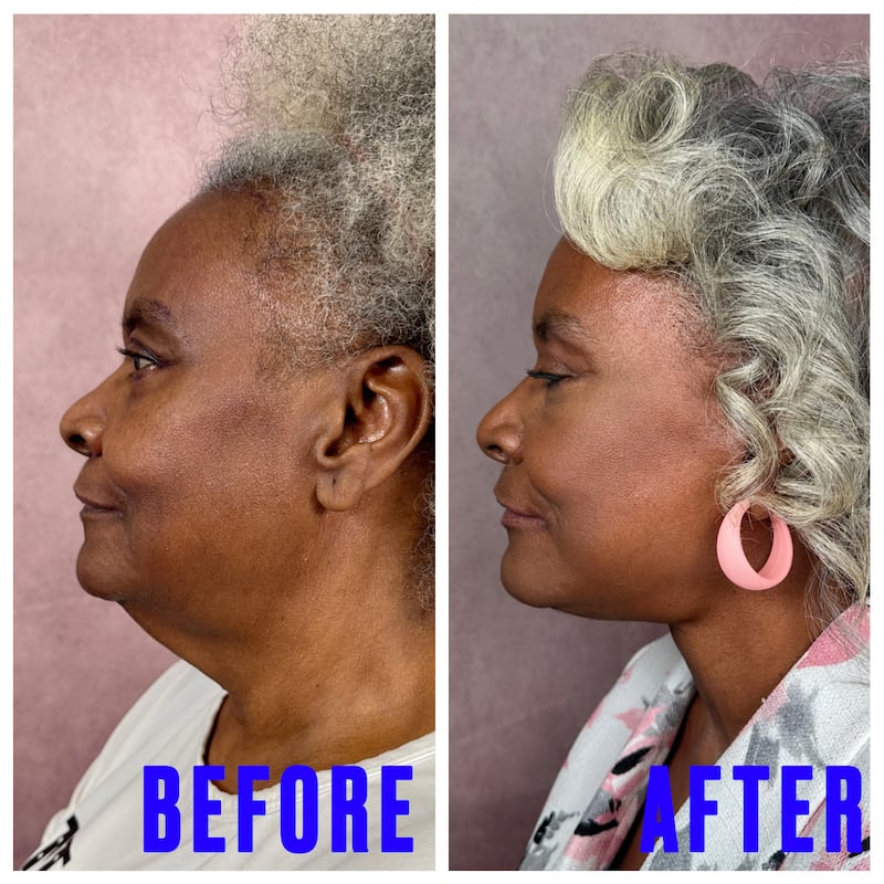 For The Looker - This Surgeon Gave His Mother a Facelift and the Results Went Viral