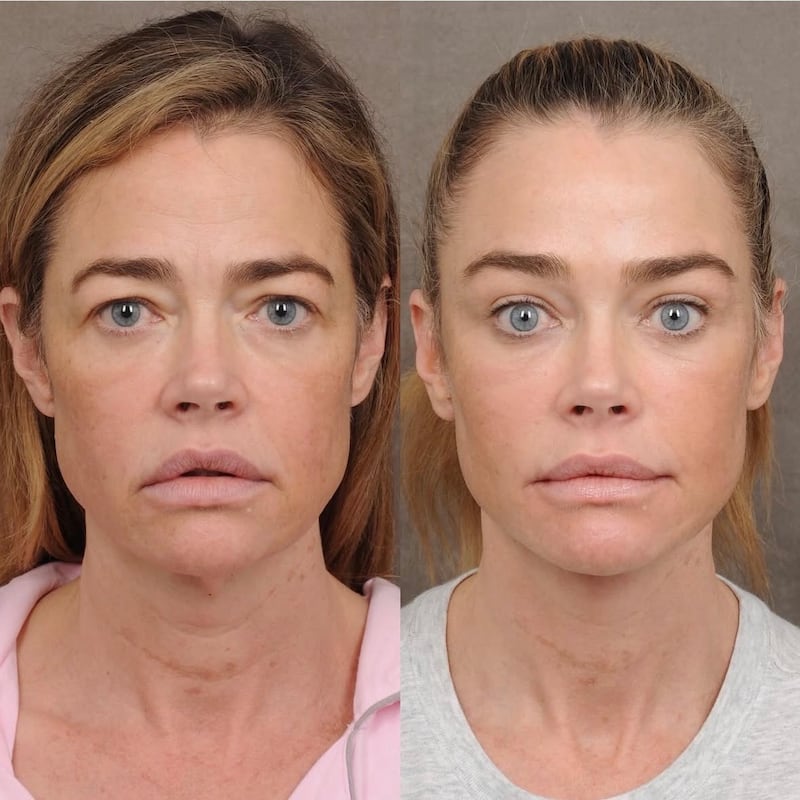 Denise Richards facelift