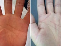 articles/2013/07/12/your-future-is-in-the-palm-of-your-surgeon-s-hand/130711-japan-palm-surgery-adelstein-tease_wc5vbl