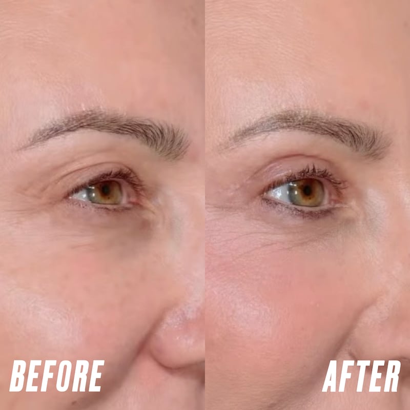 Looker - Her Upper Eyelid Surgery Took Just Two Hours But Took Years Off Her Face