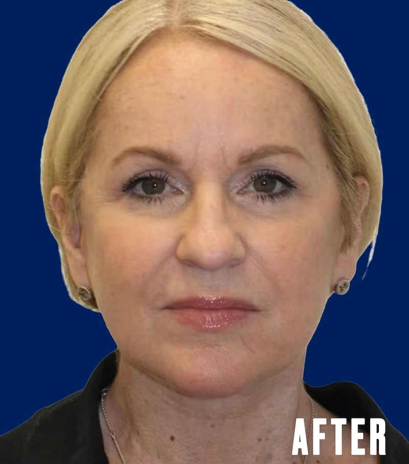 The Looker - This Woman's Facelift Had People Mistaking Her For Her Daughter