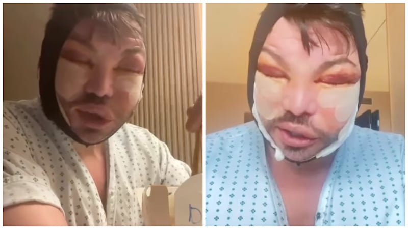 Bobby Norris after face and neck lift surgery.