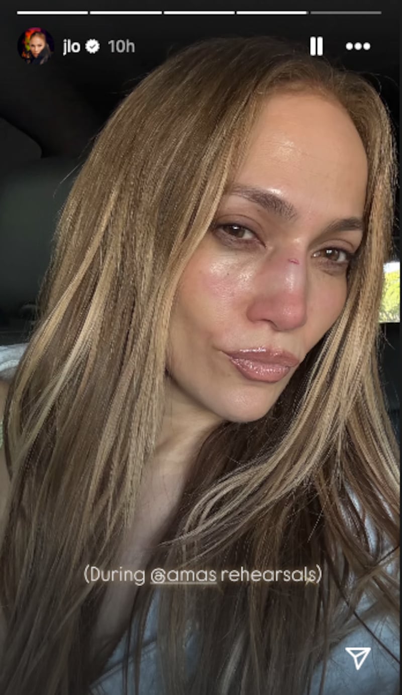 An Instagram photo of Jennifer Lopez with swelling on her mid-face and a cut on her nose.