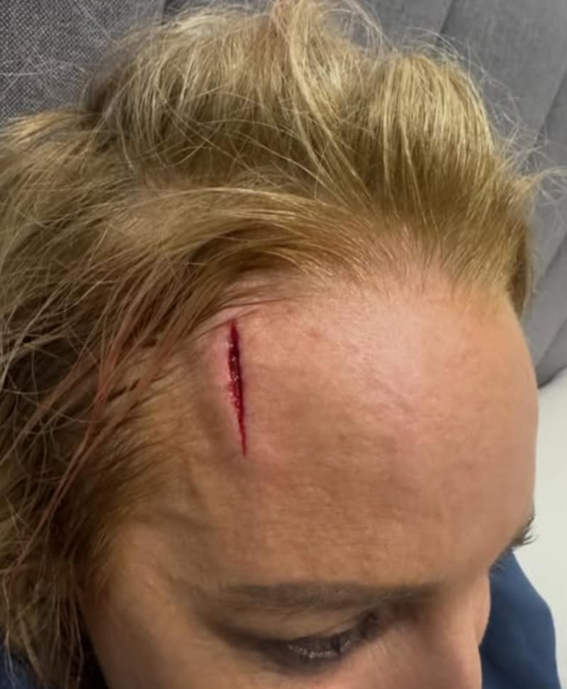 Carrie Bickmore showing her head injury
