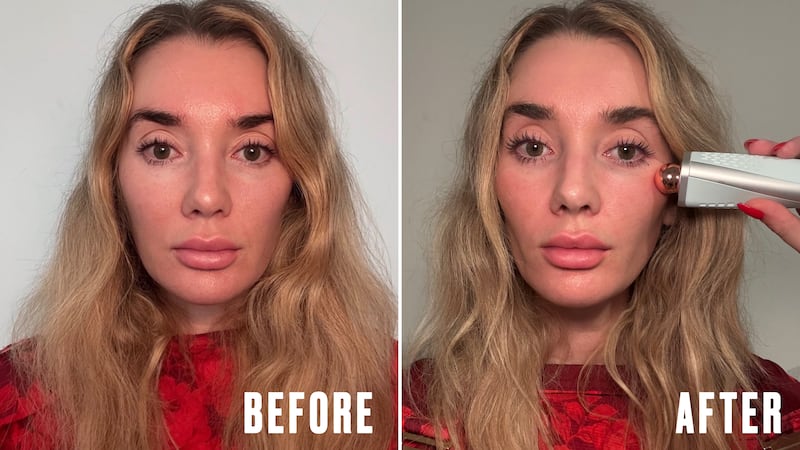 Before and After using the Dermaflash Cool Device.