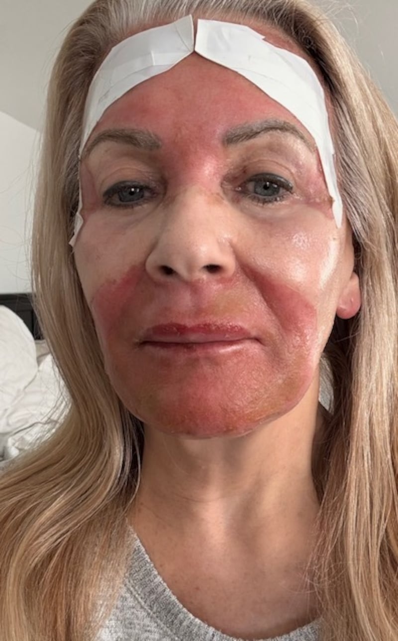 Four days after the procedure, Pamela Allyn's face was burning red and itchy.