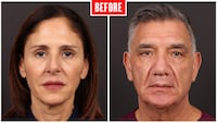 Before and after photos showing a couple who got face lifts