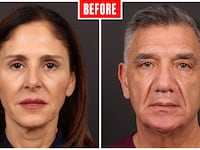 Before and after photos showing a couple who got face lifts